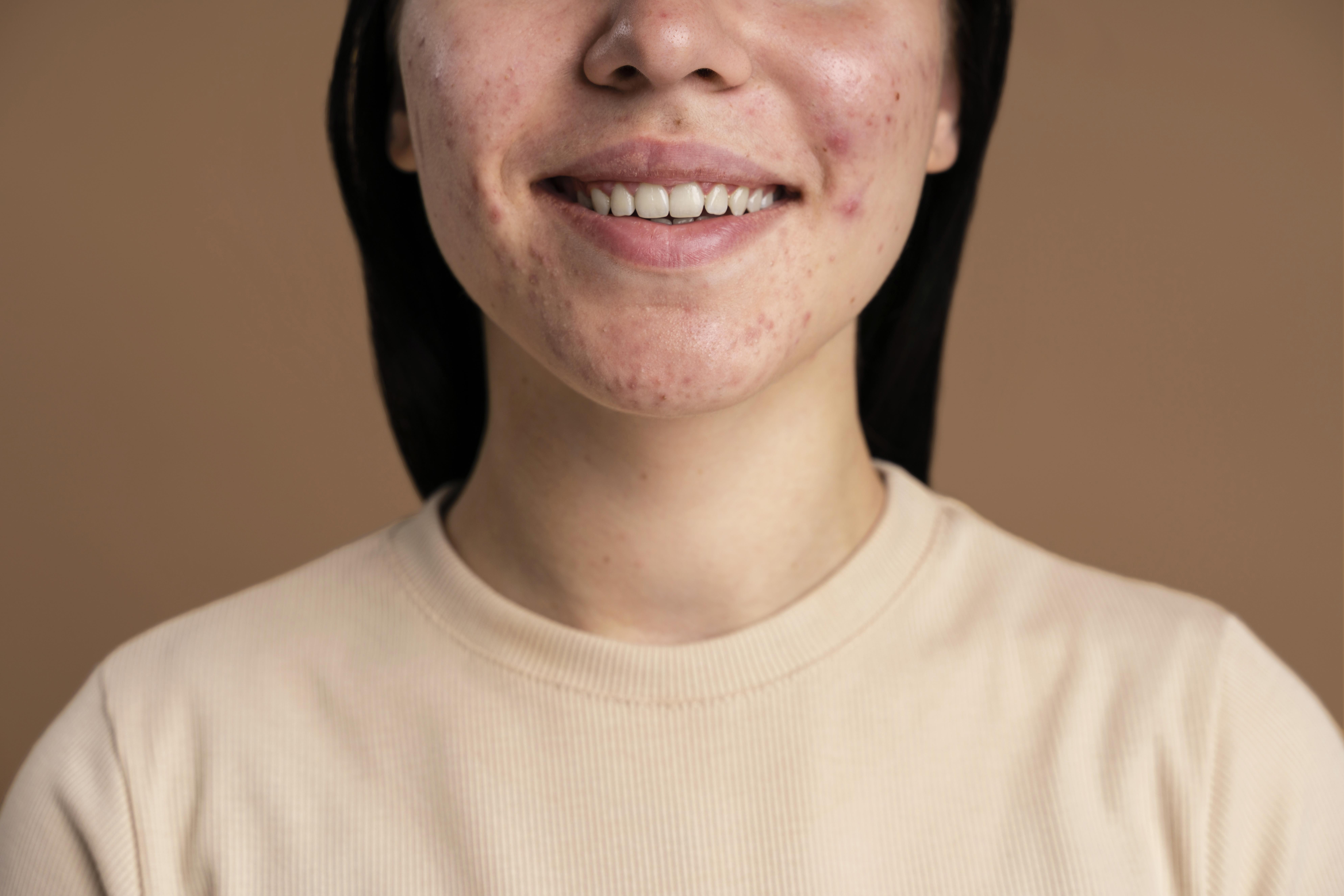 Acne: què és, com es tracta i què podem fer per prevenir-lo