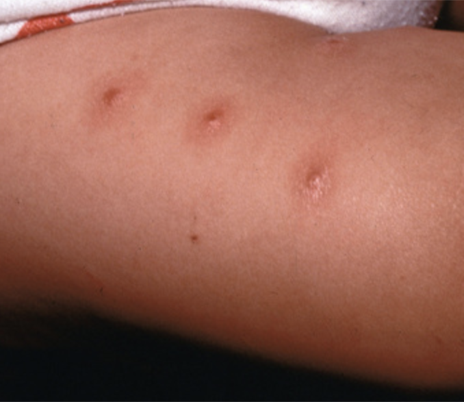 Xinxes en nens: què són, com es manifesten i quines mesures adoptar