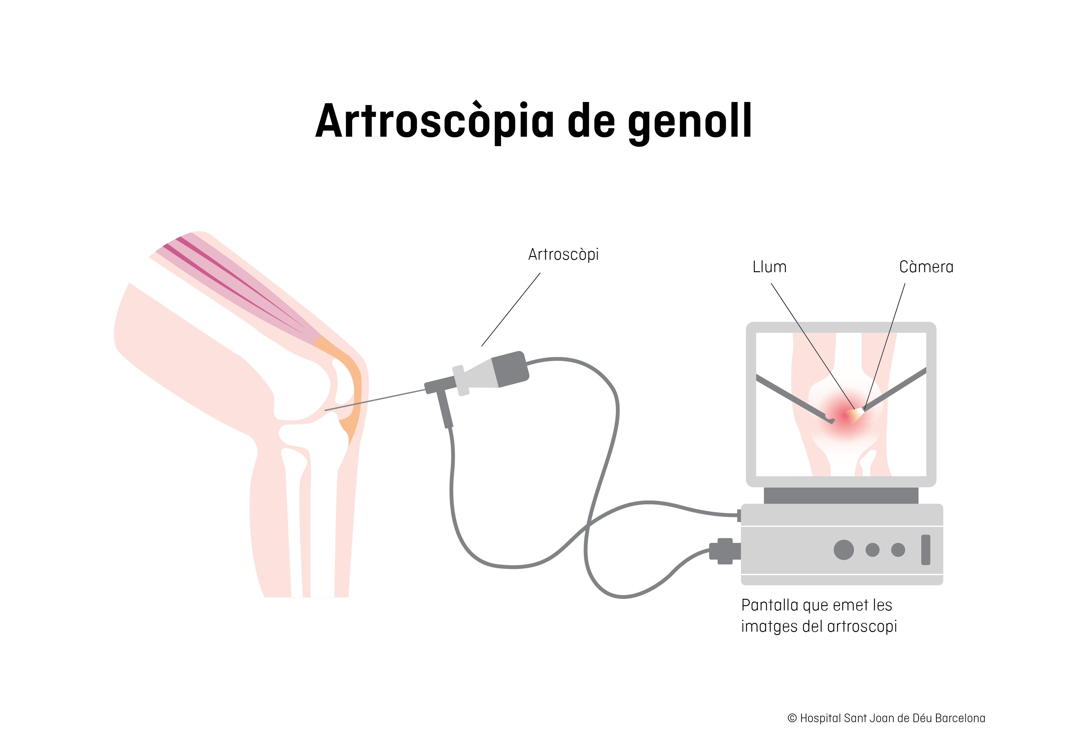 Il·lustració components de l'artroscòpia