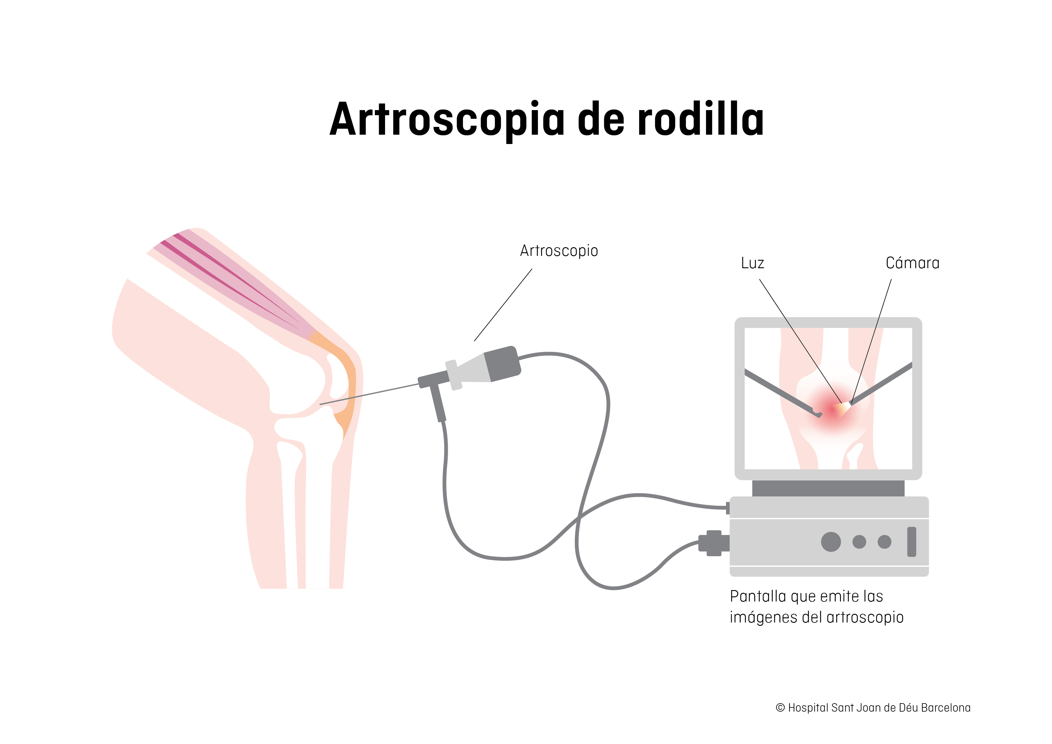 Ilustración artroscopia de rodilla