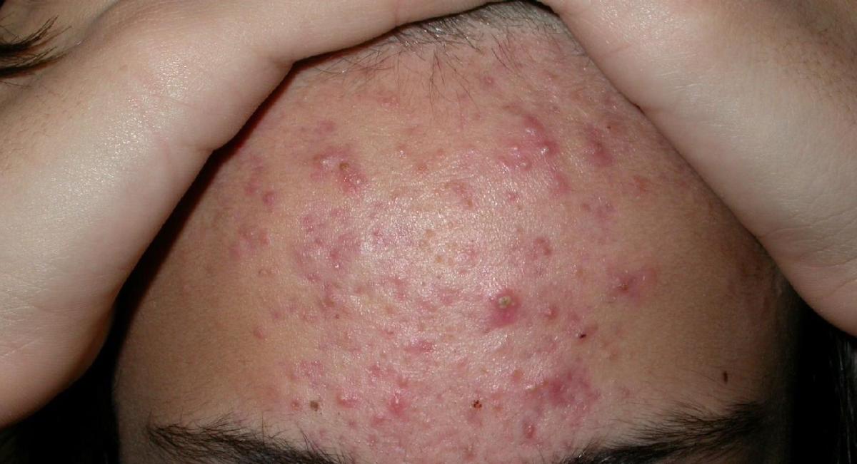 Acne papular inflamatori