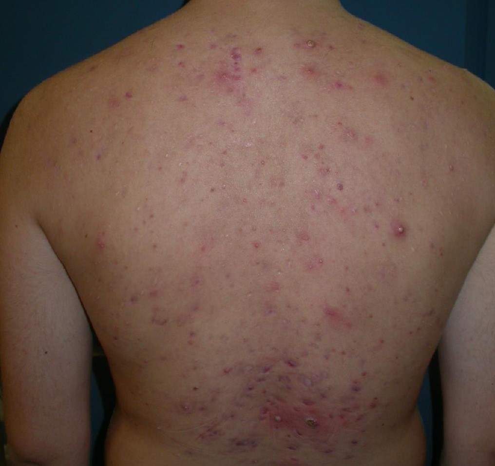 Acne quistic