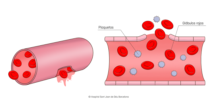 enfermedad de von Willebrand