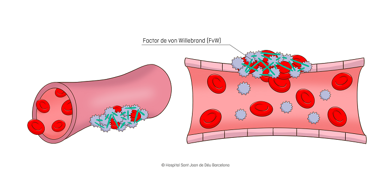 enfermedad de von Willebrand
